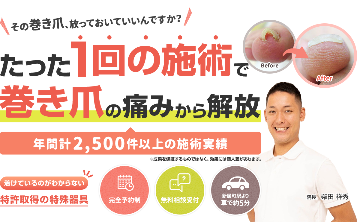 たった1回の施術で巻き爪の痛みから解放