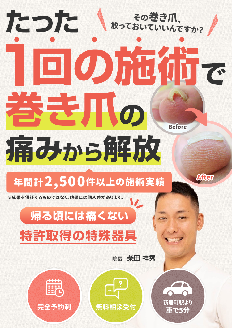 たった1回の施術で巻き爪の痛みから解放
